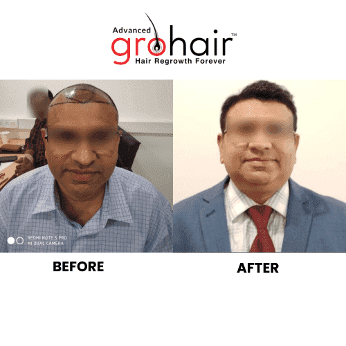 Hair Transplant Before After Result 1