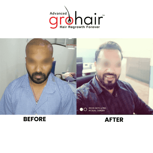 Hair Transplant Before After Result 2