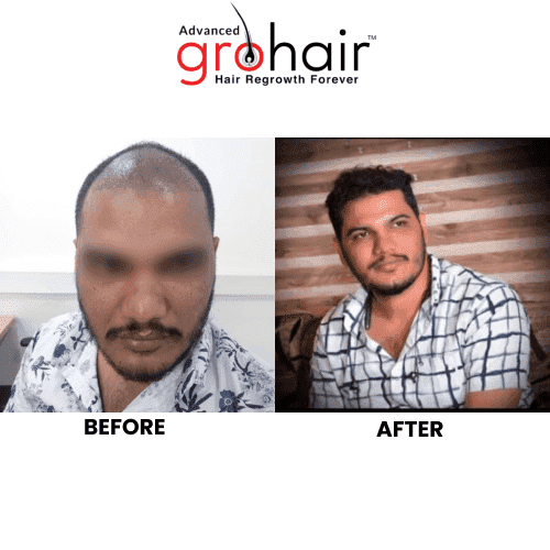 Hair Transplant Before After Result 3