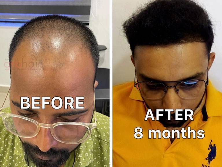 Hair Transplant Before and After Results